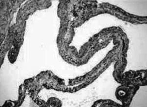 Imagen microscópica del linfangioma.