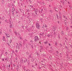 Hematoxilina-eosina 40X. Detalle atipia citológica del componente estromal.