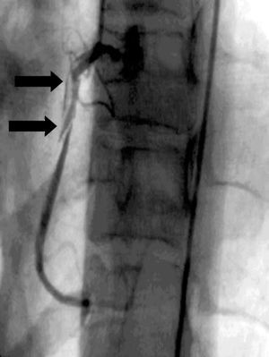 Disección espontánea aguda de la arteria coronaria derecha.