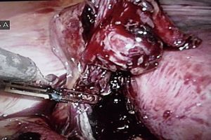 Salpingectomía izquierda perlaparoscopia.