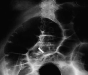 Radiografía simple de abdomen donde se observa la dilatación colónica.