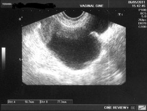Ecografía vaginal. Quiste de ovario. Se ve la zona de comunicación vejiga-divertículo.