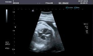 A nivel subvalvular tricuspídeo se visualiza imagen hiperecogénica de unos 8mm, móvil y sólida. Birrefringencia subvalvular.