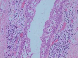 Carcinoma in situ, estudio anatomo patológico.