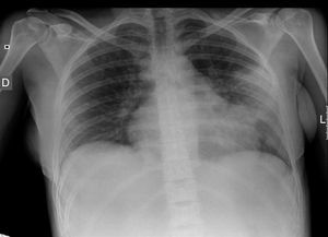 Radiografía de tórax con aumento de densidad en zona media de hemitórax izquierdo, compatible con neumonía lobar izquierda.