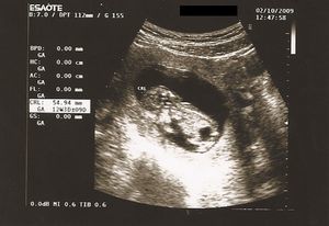 Ecografía fetal de 12 semanas’.