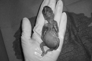 Resultado abortivo de feto con megavejiga fetal.