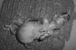 Resultado abortivo de feto con megavejiga fetal.