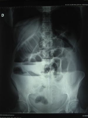 Radiografía de abdomen AP en bipedestación en la que se observan la distensión del intestino delgado y grueso y los niveles hidroaéreos.
