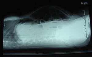 Radiografía de abdomen en decúbito en la que se observa la distensión de asas de intestino, los niveles hidroaéreos y el neumoperitoneo.