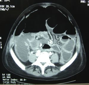 TAC abdominal en el que se observan las asas de intestino dilatadas y la presencia de neumoperitoneo.