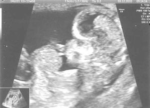 Onfalocele fetal. Semana 12.