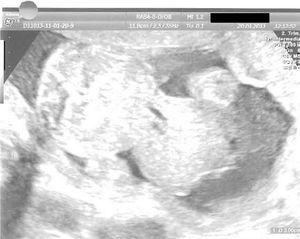 Onfalocele fetal. Semana 28.