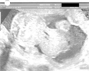 Onfalocele fetal. Semana 28.