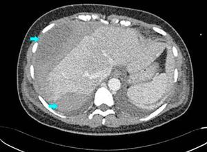 TAC con contraste i.v. al inicio del cuadro (2/01/2008). Presencia de gran hematoma hepático subcapsular que cubre toda la superficie hepática anterior y otro hematoma posterior (flechas). A pesar de la evidencia clínica de sangrado hepático en días posteriores, el hematoma no modificó de forma importante este volumen.