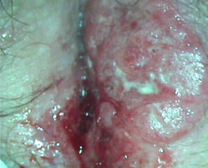 Tumoración exofítica ulcerada en labio mayor izquierdo que llega hasta el rafe perineal y mínimamente en el lado derecho.