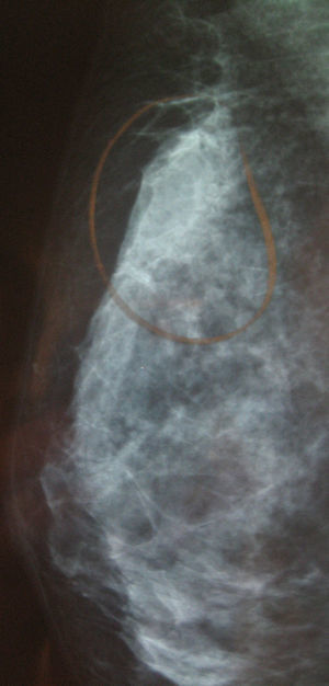 Mamografía donde se visualiza en cuadrante superoexterno una densidad asimétrica sin observarse un claro nódulo predominante.