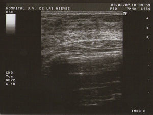 MFQ de pequeñas formaciones.