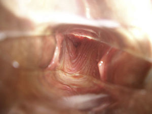 Imagen macroscópica. Tabique vaginal longitudinal, al fondo.
