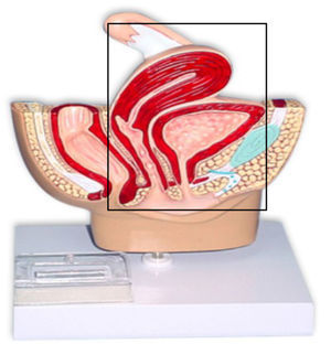 Exenteración pélvica anterior.
