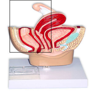 Exenteración pélvica posterior.