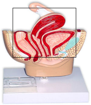 Exenteración pélvica total.