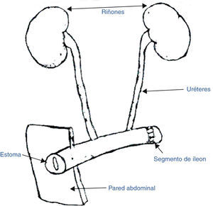 Ureteroileostomía cutánea tipo Bricker-Wallace II.