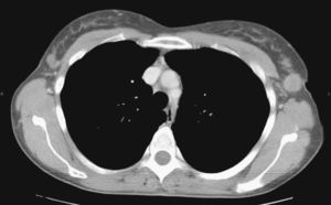 Tomografía axial computarizada de cáncer de mama ectópico axilar.