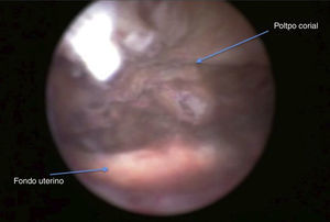 Imagen obtenida durante la histeroscopia quirúrgica, en la que se aprecian restos coriales, con zonas necrosadas en la cara anterior y el fondo uterino.
