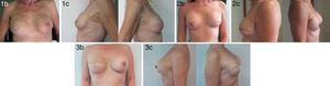 Pacientes tras recambio de expansor con prótesis y mastectomía subcutánea lateral y reconstrucción con prótesis.