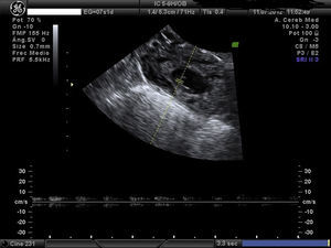 Saco gestacional y embrión con actividad cardíaca positiva a nivel de cuerno derecho.