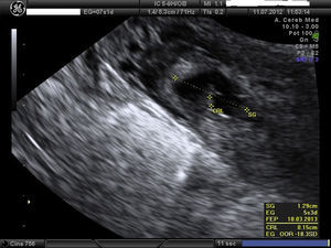 Saco gestacional de 13mm con embrión de CRL 15mm y actividad cardíaca positiva.