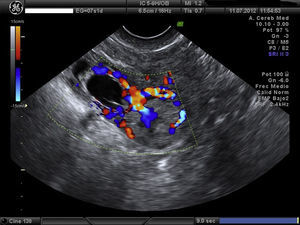 Formación ecogénica mal delimitada de 18×18mm, muy vascularizada, compatible con trofoblasto a la izquierda del saco gestacional.