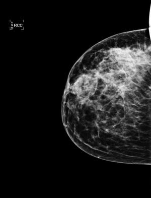 Mamografía: se observa un aumento difuso de la radiodensidad, con claro incremento de la trabeculación, preferentemente a nivel de los cuadrantes externos, más focalizada en el cuadrante supero-externo. También afecta al plano cutáneo, preferentemente a nivel del complejo aréola-pezón, el cual engrosa y retrae.