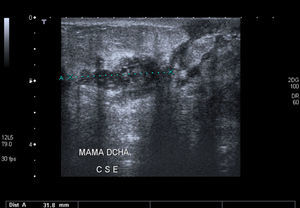 Ecografía: engrosamiento de los diferentes planos tisulares. Clara focalización del proceso, ya que existe un efecto de masa de 4cm aproximadamente en el cuadrante supero-externo.