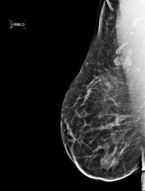 Mamografía: el aumento de densidad a nivel de cuadrante supero-externo de la mama derecha ha disminuido en probable relación con la resolución de su mastitis granulomatosa.