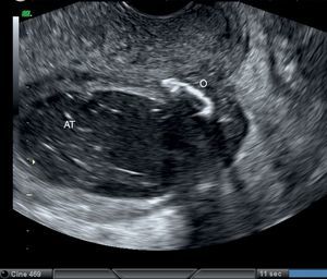 Corresponde a la ecografía transvaginal donde se identifica un absceso tubárico (AT) y adyacente al mismo el ovario con un quiste dermoide (O).