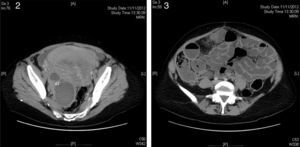 Corresponden a la TC. Podemos identificar el absceso tubárico (AT), así como la distensión de asas intestinales o íleo adinámico.