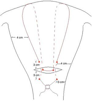 Plicatura de B-Lynch.