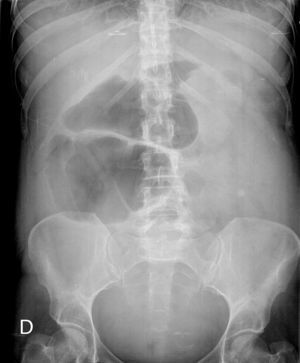 Rx abdominal.