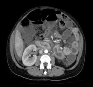 TC toracoabdominal.