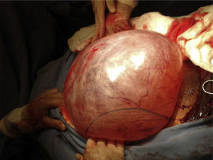 Extracción de tumoración de cavidad abdominal.