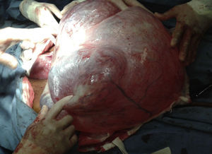 Tumoración fuera de cavidad abdominal.