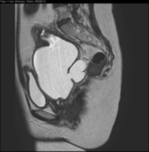Corte sagital donde se muestra el hematocolpos y hematosalpinx izquierdo.
