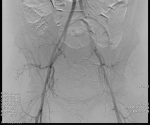 Angiografía pélvica de control tras embolización bilateral con detección del flujo de ambas arterias uterinas.