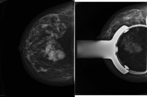 Mamografía: masas nodulares de alta densidad con bordes bien definidos a nivel de UCS de mama derecha.