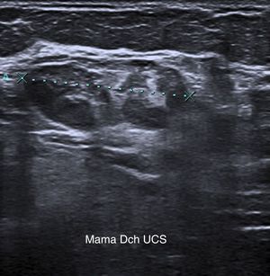 Ecografía mamaria: tumoración heterogénea de 35×20mm, compuesta por varios nódulos en UCS de mama derecha.