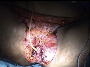 Vista panorámica tras exéresis de la lesión.