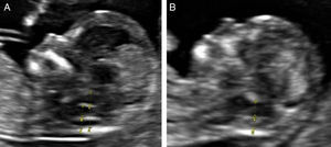Comparación entre feto normal (A) y feto afecto de EBA (B). Nótese en B como solo es posible identificar 3 líneas ecogénicas paralelas que delimitan 2 espacios.