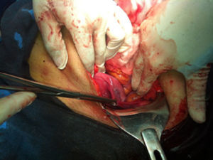 Hallazgos durante cesárea, agenesia de salpinge y ovario izquierdo.